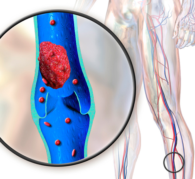 Тромбоз Варикозных Вен