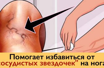 Избавляемся от «СОСУДИСТЫХ ЗВЕЗДОЧЕК» на ногах без операций и лекарств!