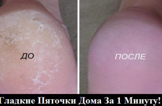 Супер-средство для ваших пяточек! Помогает за минуту!