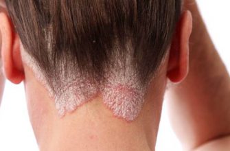 Новое исследование: избавиться от псориаза можно всего за 1 неделю!