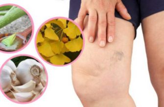 Моя бабушка научила меня этому средству, чтобы избавиться от варикозных вен. Теперь мои ноги выглядят отлично!