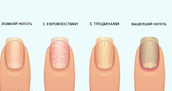 Предупреждающие признаки ваших ногтей о вашем здоровье