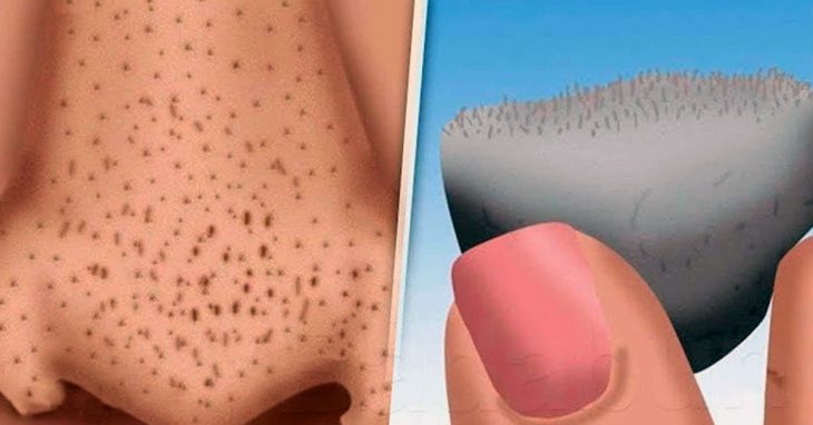 Устранить черные точки, очистить кожу и выровнять ее тон всего за 3 минуты поможет это средство!