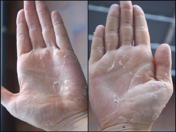 Как избавиться от шелушения кожи на ладонях