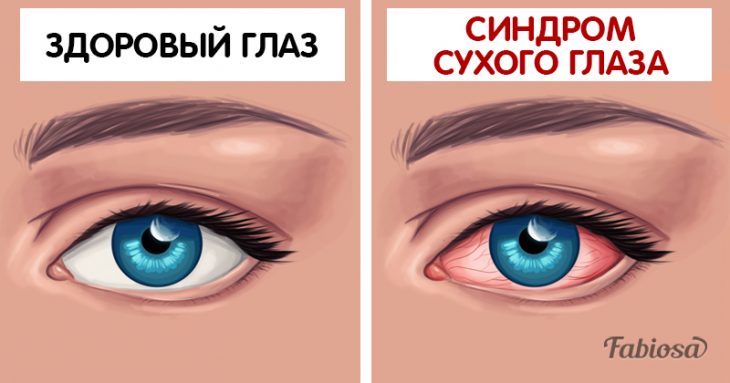 Постоянная сухость глаз — распространённый синдром. Почему ваши глаза сохнут и что с этим делать?