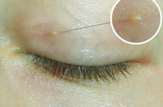 ПОЯВЛЕНИЯ ЖИРОВИКОВ ВОКРУГ ГЛАЗ