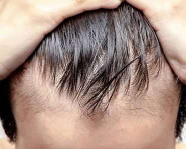 Растительные средства для лечения облысения, выпадения волос или алопеции