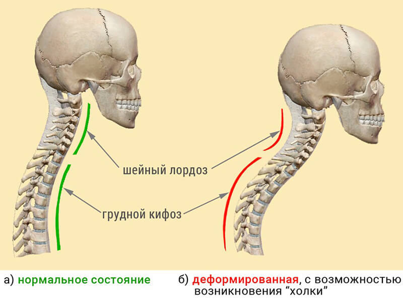 Лордоз и кифоз фото