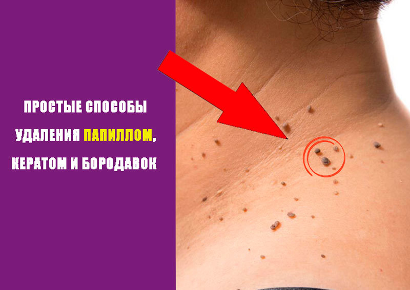 Простые способы удаления папиллом, кератом и бородавок - Сайт для женщин