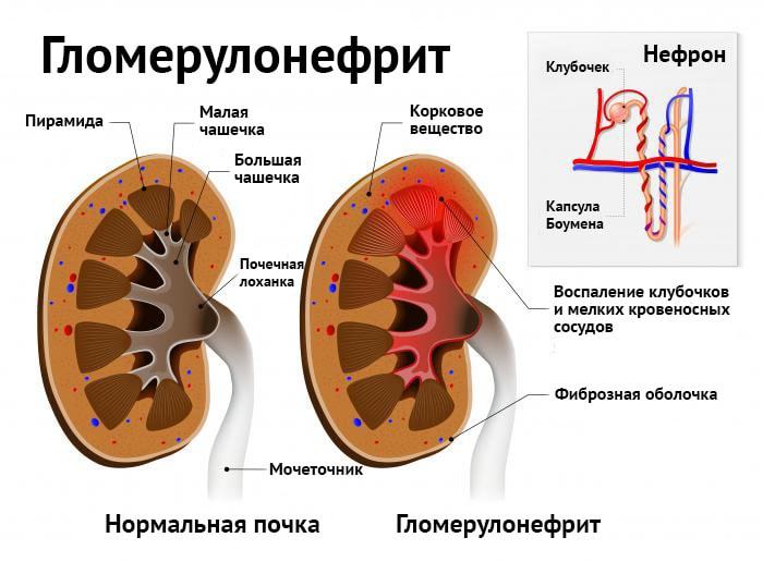 Изображение генеративной почки