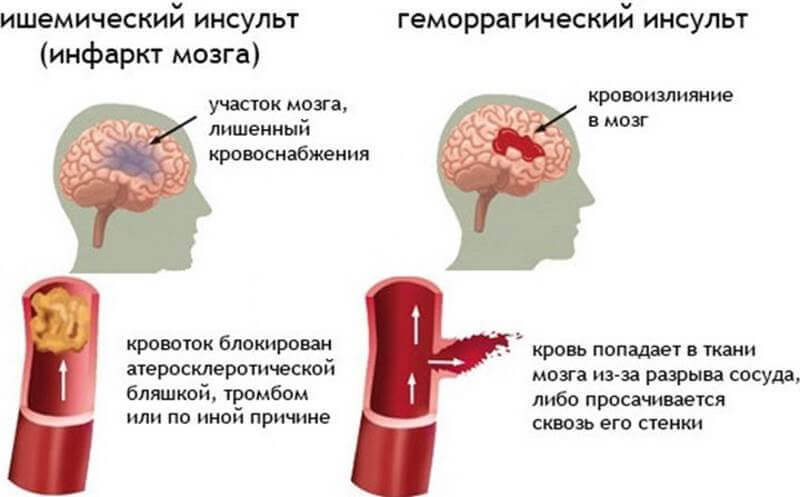 Ишемический инсульт и геморрагический инсульт картинки