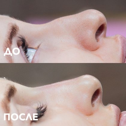 Без отеков и боли: как изменить форму носа, чтобы стать красивее